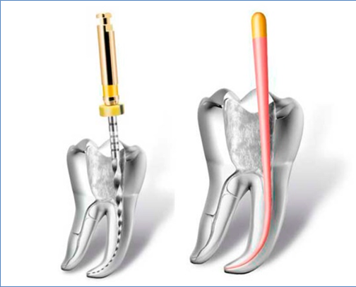 Endodoncia